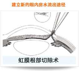 建立新的眼內(nèi)房水流出途徑