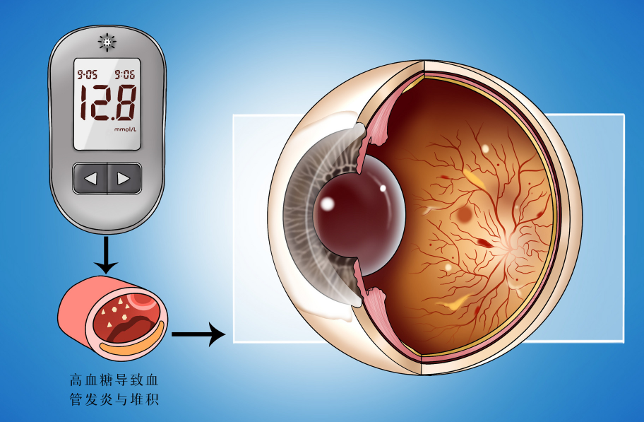 糖尿病視網(wǎng)膜病變