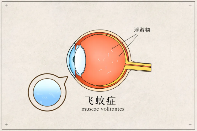 飛蚊癥癥狀