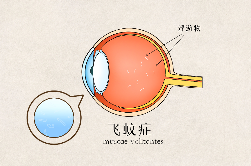 飛蚊癥癥狀