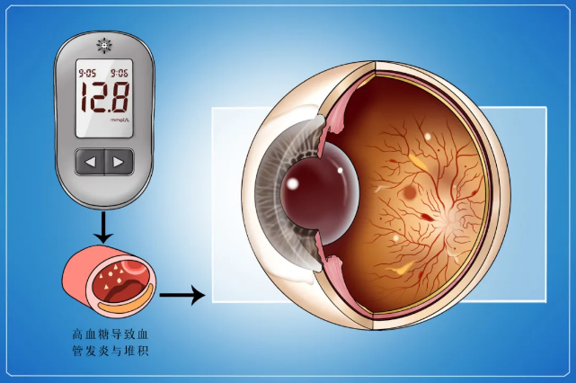 糖尿病視網(wǎng)膜病變