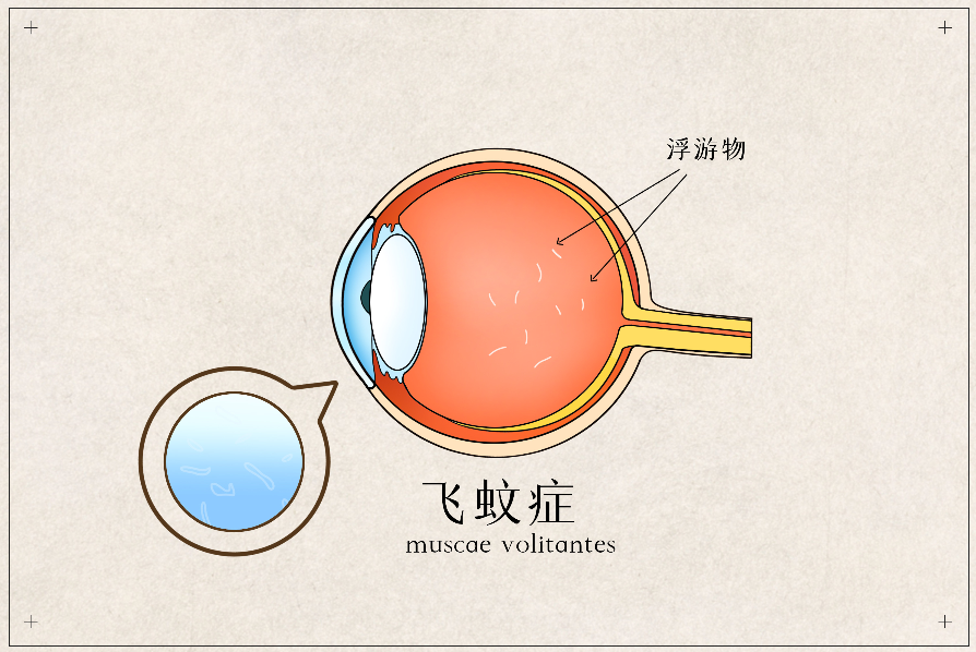 得了飛蚊癥可以治嗎